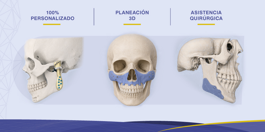 Implantes personalizados maxilofaciales