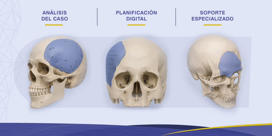 Implantes personalizados para neurocirugía